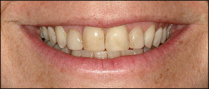Oakville Dental Veneers